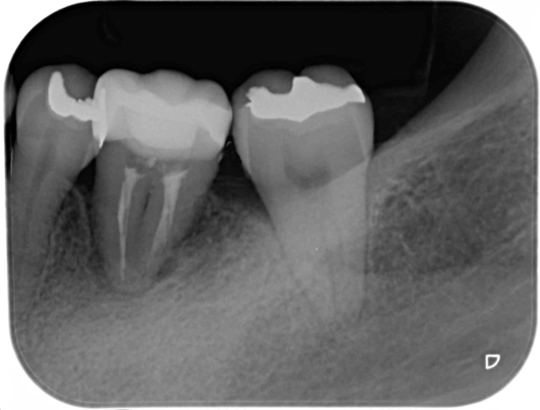 歯の移植・再植の治療例 - エス歯科クリニック（中野区・新中野駅）